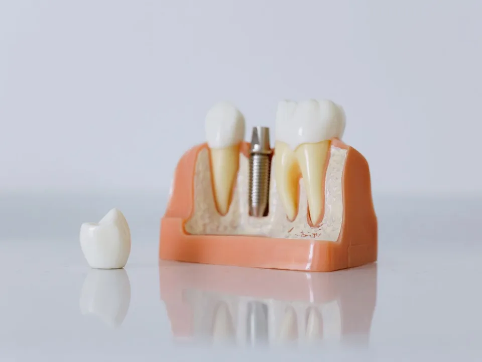 Titanium implant and porcelain crown in a jaw cross-section model
