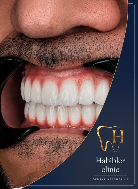 Full-arch implant restoration — after, front view