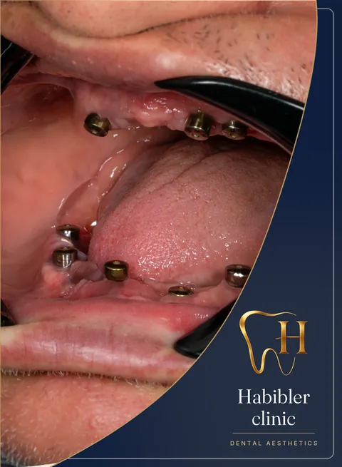 Full-arch implant restoration — during treatment, implants in place