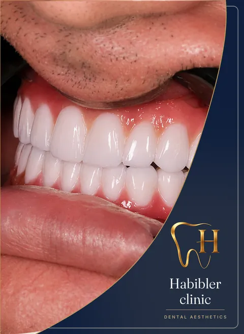 Full-arch implant restoration — after, front view